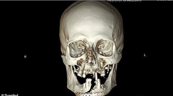 Дед случайно распилил себе лицо бензопилой и добрался в больницу, преодолев 32 км 68-летний житель Австралии, Билл Синглтон, распиливал здоровенное бревно в лесу, когда бензопила отскочила и